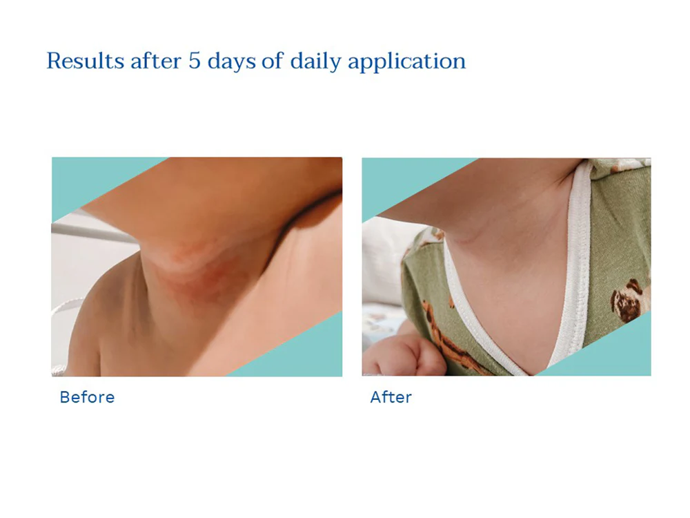 Stelatopia intense eczema relief - Image 5